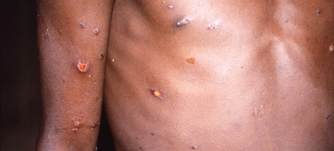 2022-05-19t154353z_1_lynxnpei4i0ra_rtroptp_4_health-monkeypox-country