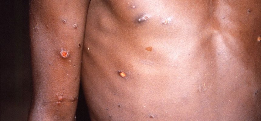 2022-05-19t154353z_1_lynxnpei4i0ra_rtroptp_4_health-monkeypox-country