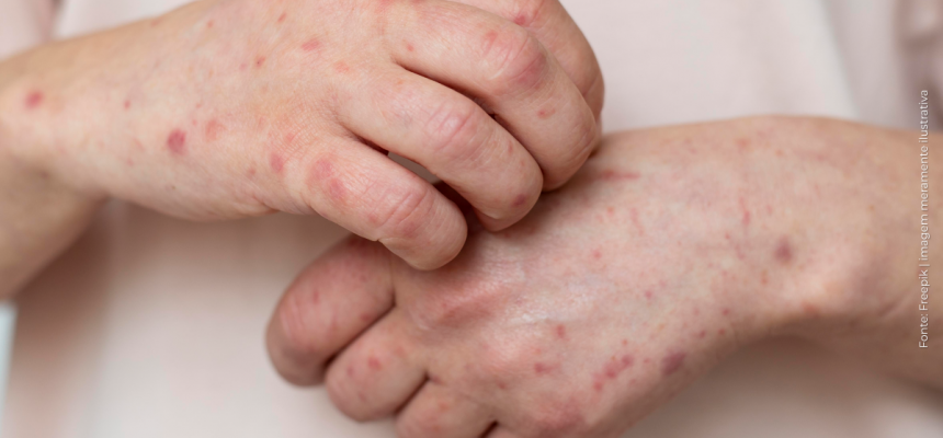 20260226_monkeypox_news